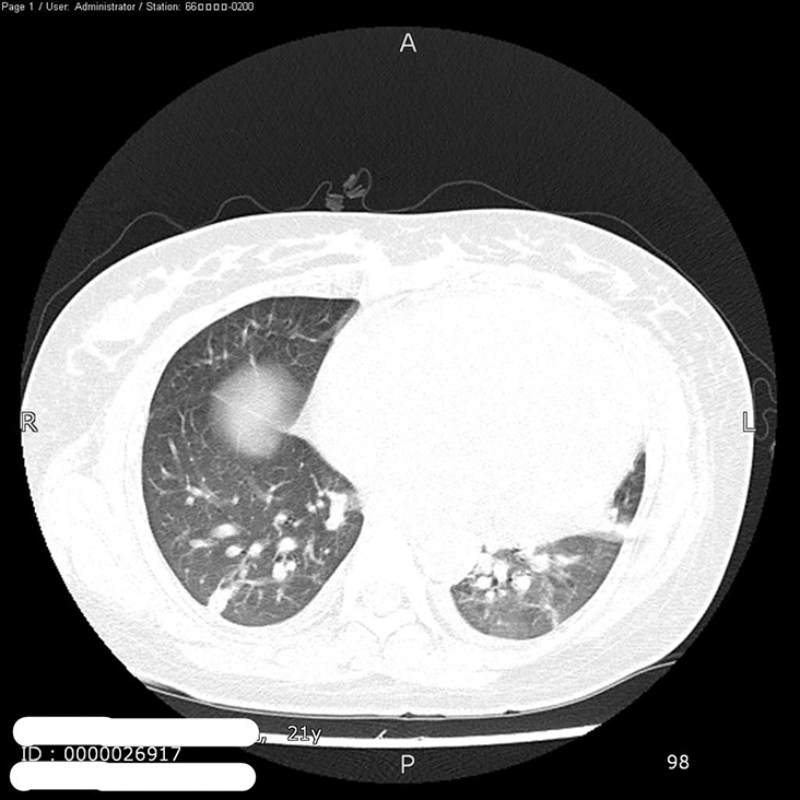 图2 肺部CT.jpg